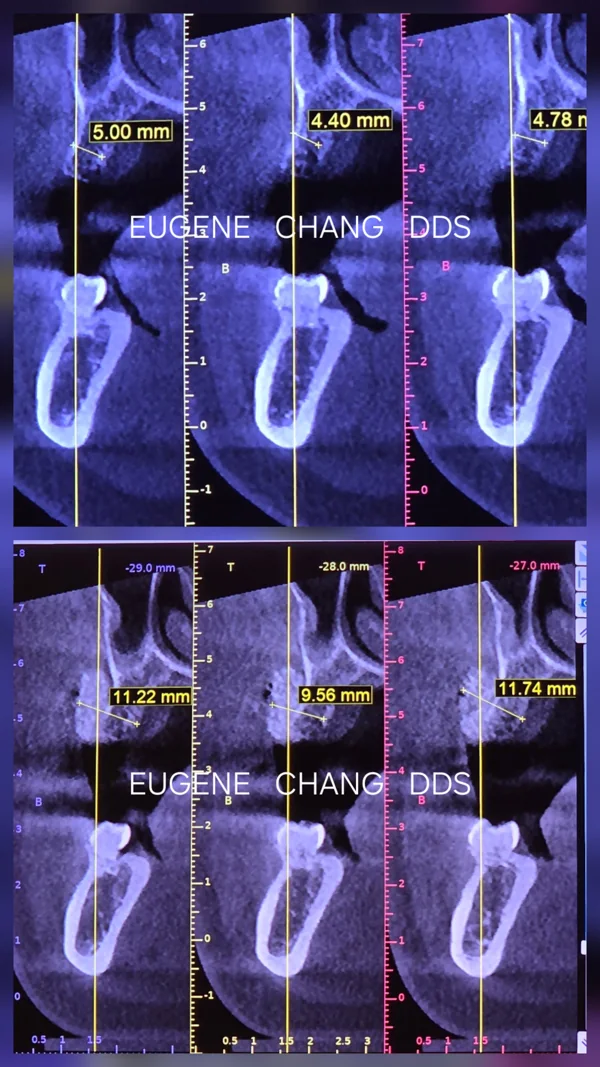 Cone beam CT slices of the jaw with bone height and width measured in millimetres