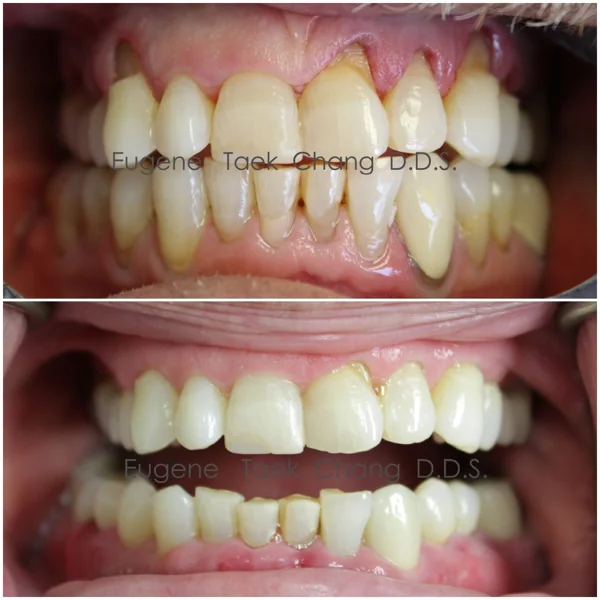 Front teeth with receding gums, then the same teeth with the gums covering the roots