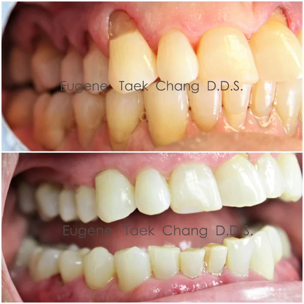 Upper teeth with exposed roots, then the same teeth with the gumline restored
