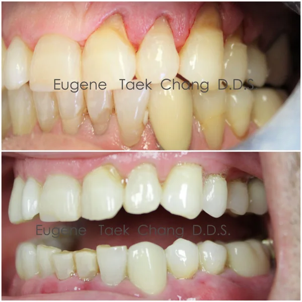 Receding gums on the upper teeth, then the same teeth after treatment