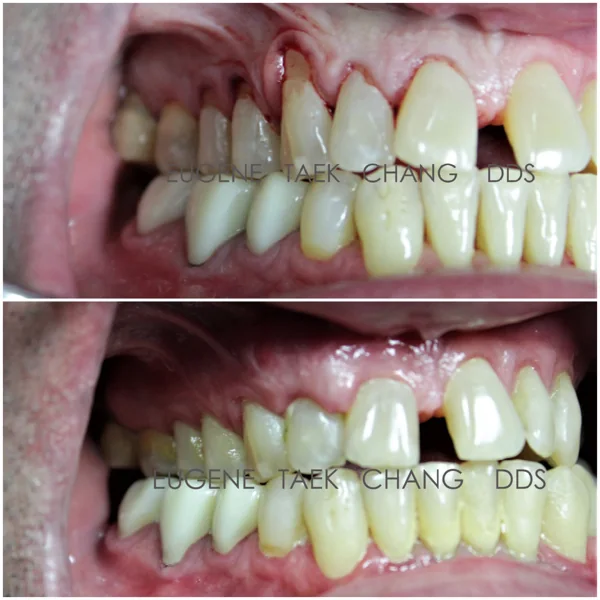 Side view of receding gums, then the same teeth with the roots covered