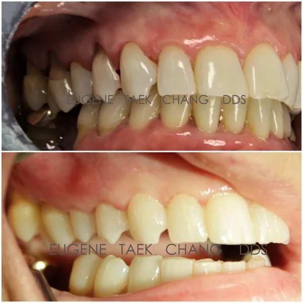 Side view of exposed roots on the lower teeth, then the same teeth after treatment