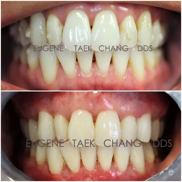 Front teeth with gum recession, then the same teeth with a fuller gumline