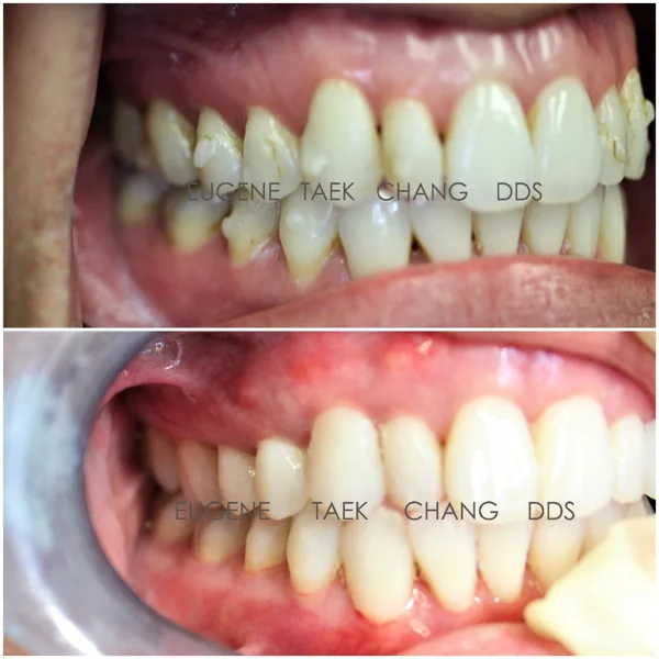 Side view of receding gums, then the same teeth after treatment