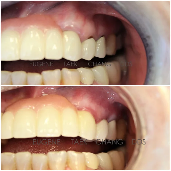Upper front teeth with gum recession, then the same teeth after treatment
